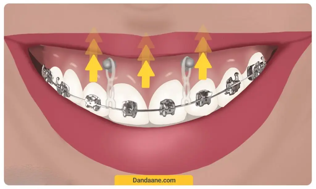 درمان لبخند لثه ای با ارتودنسی