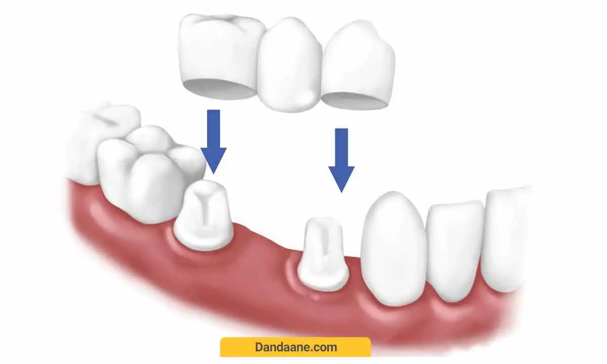 بریج دندان سنتی