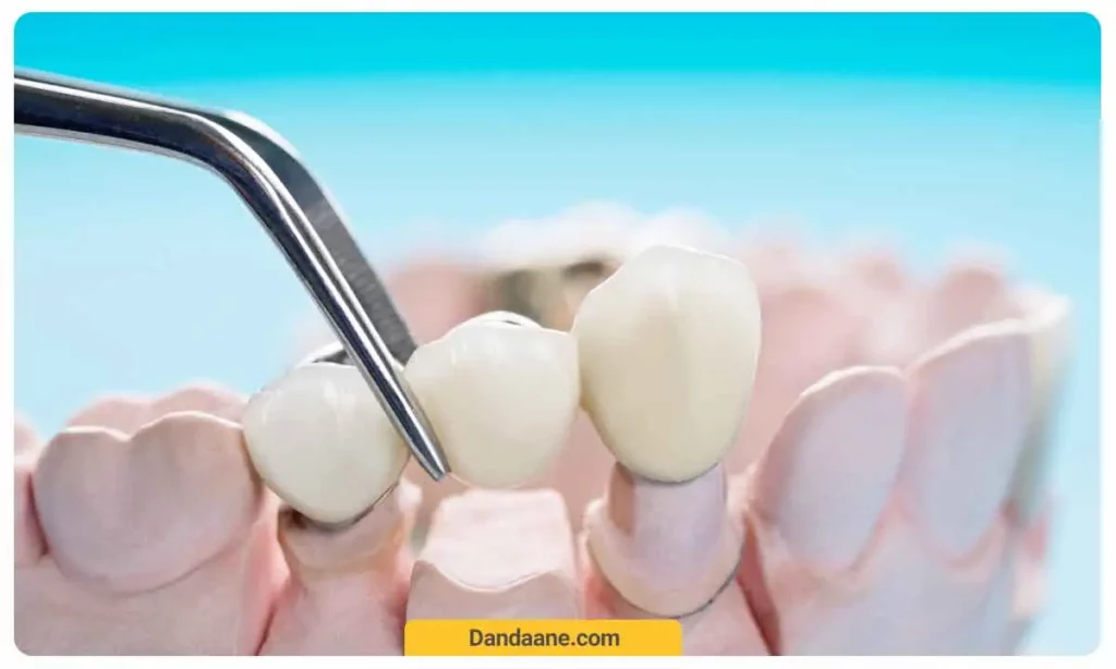 هزینه بریج کانتی لور چقدر است