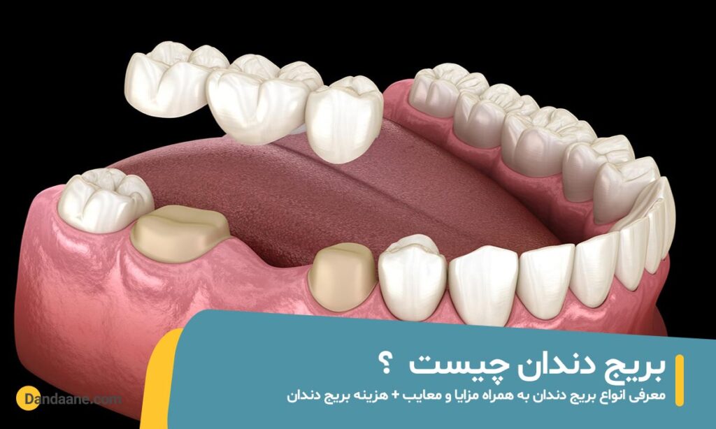 بریج دندان چیست