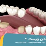 بریج دندان چیست