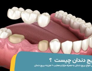 بریج دندان چیست