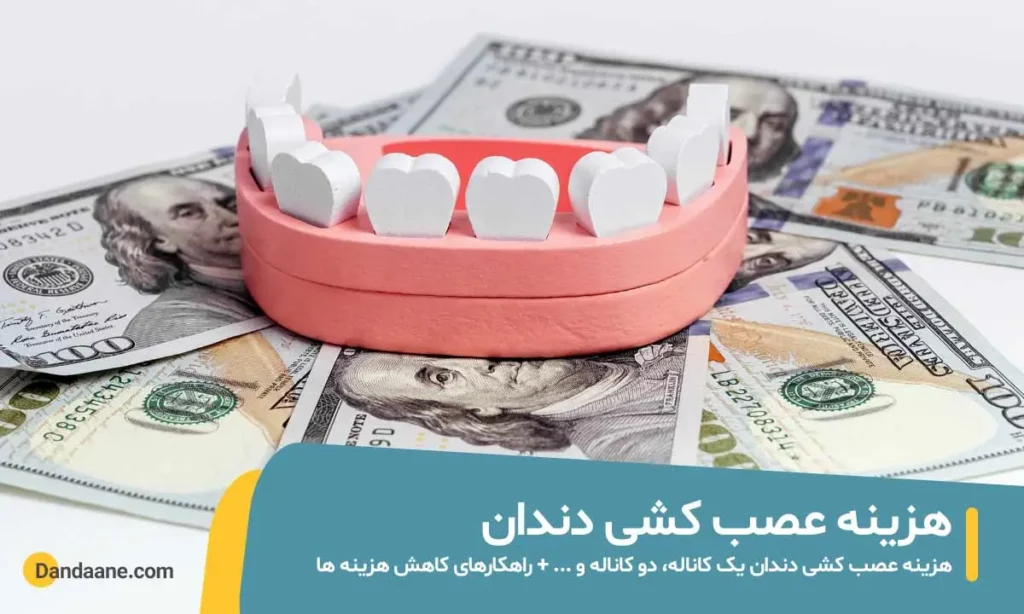 هزینه عصب کشی دندان