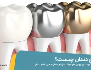 تاج دندان چیست