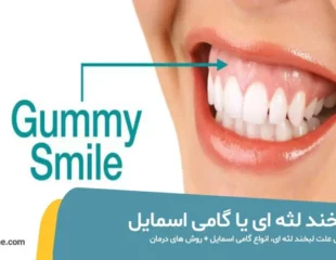 لبخند لثه ای