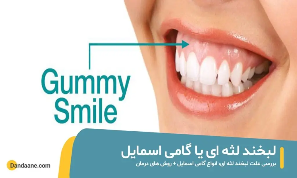 لبخند لثه ای