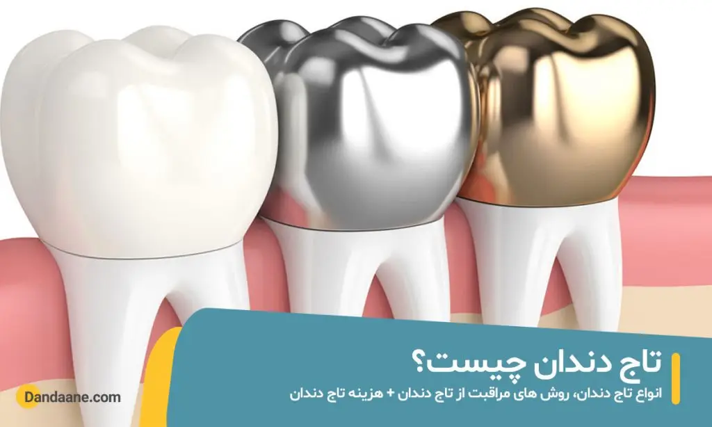 تاج دندان چیست