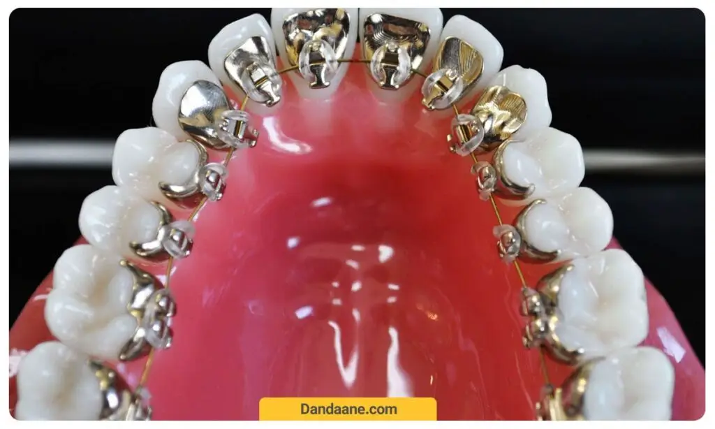 ارتودنسی از داخل دندان 