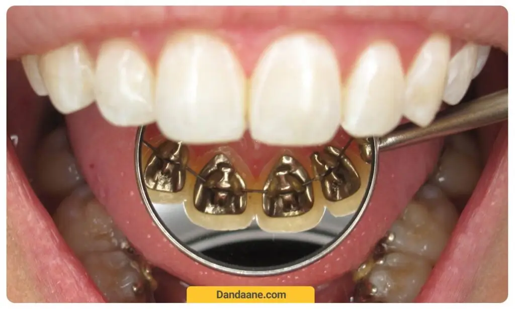 تصویر ارتودنسی لینگوال داخل دهان 