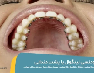 ارتودنسی لینگوال یا پشت دندانی