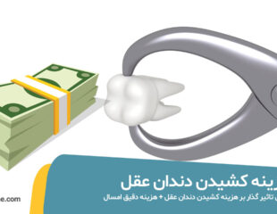 هزینه کشیدن دندان عقل