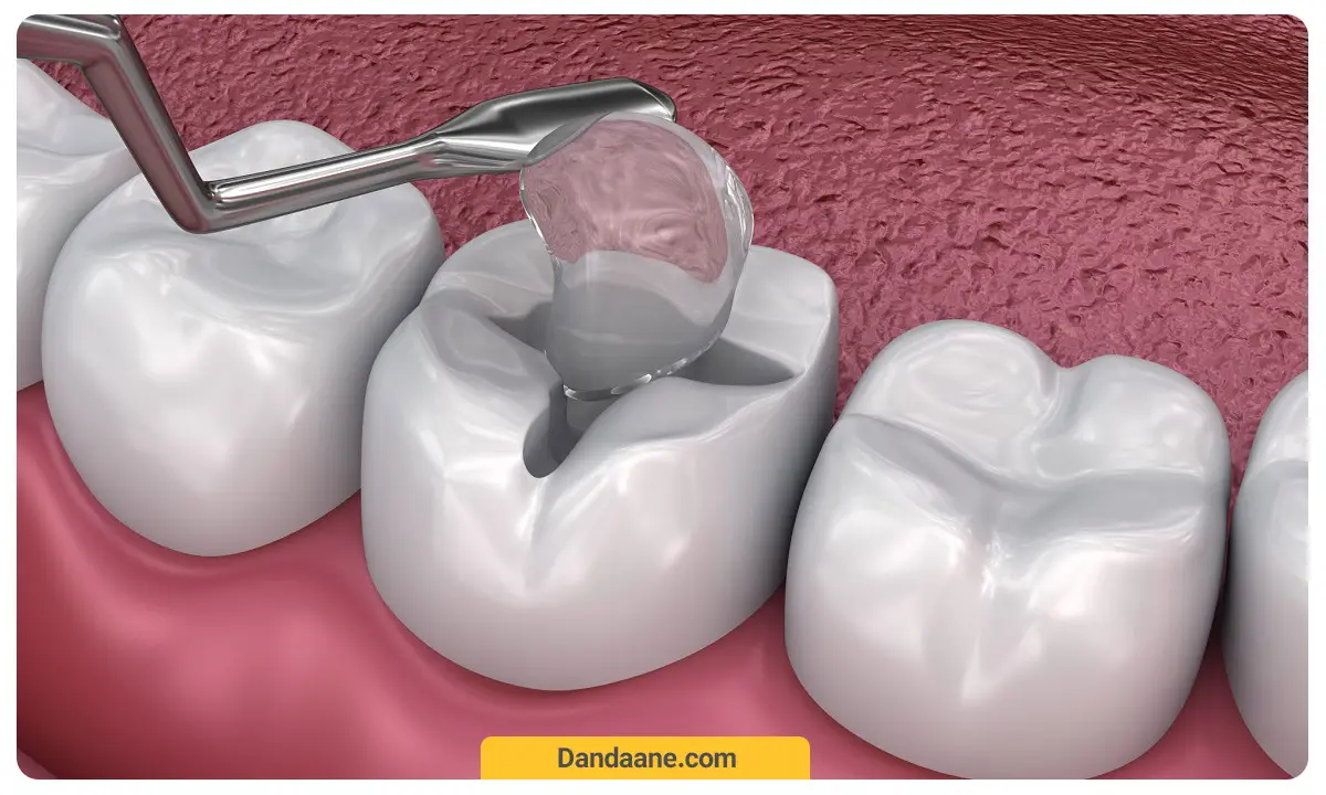 پر کردن دندان