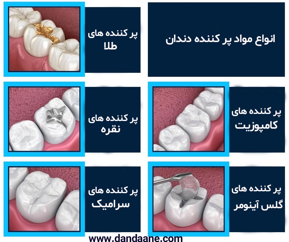 انواع مواد پر کننده دندان
