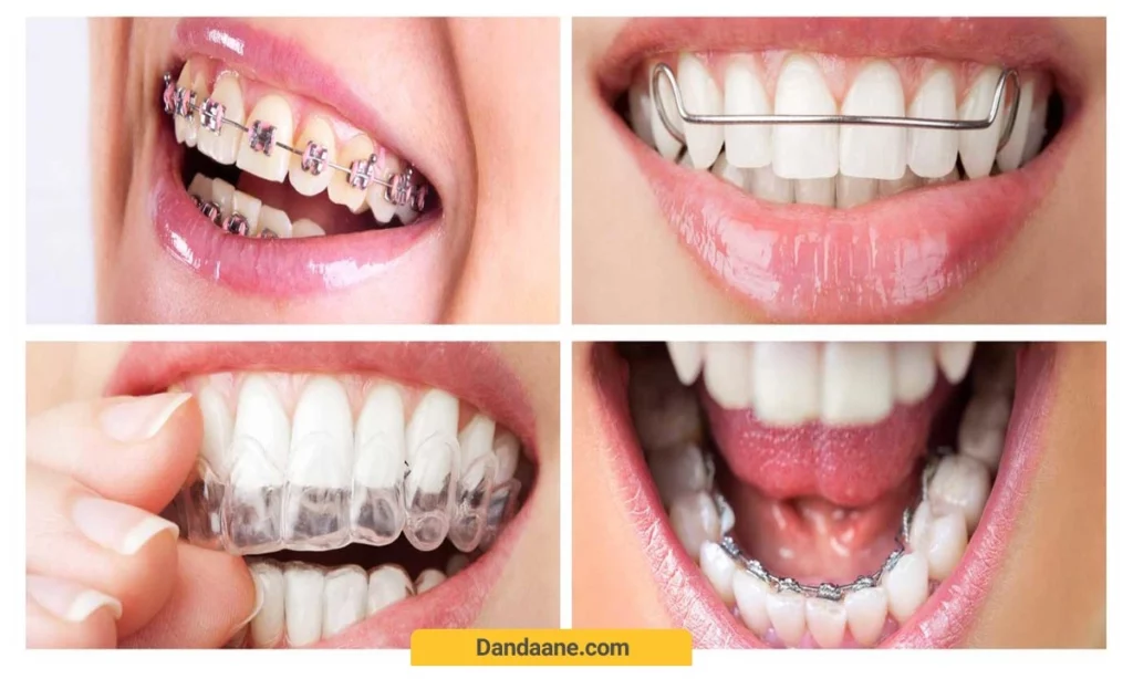 انواع ارتودنسی دندان
