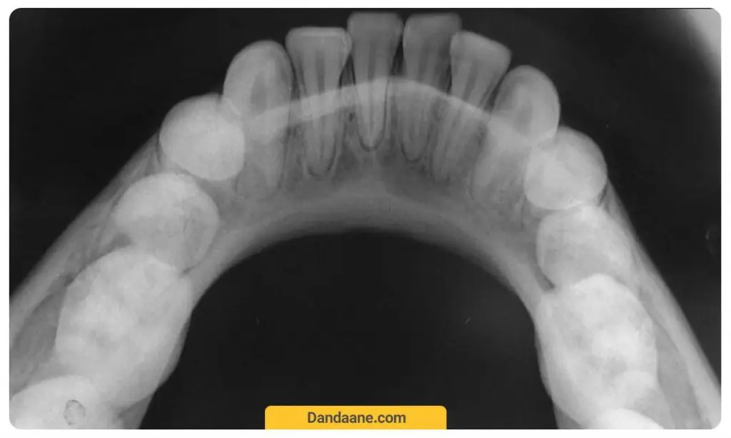عکسبرداری از دندان 