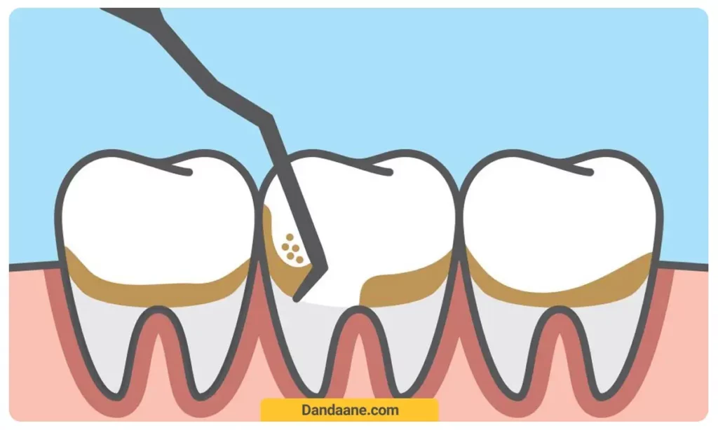 جرمگیری دندان ها