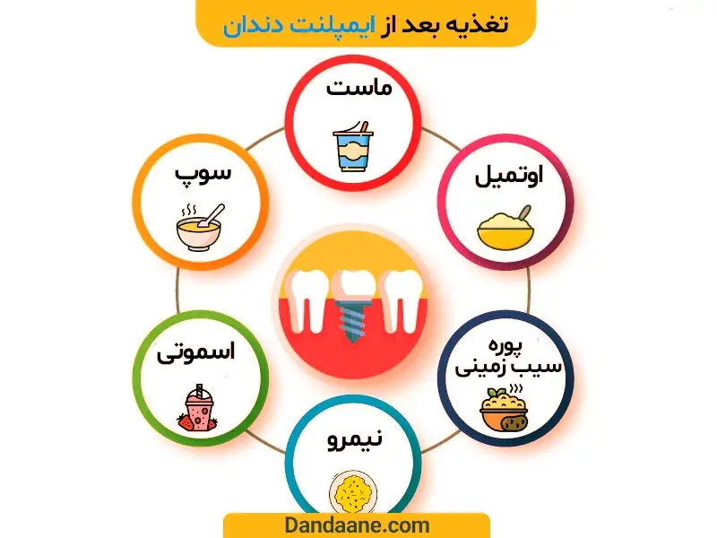 تصویر اینفوگرافیک تغذیه پس از ایمپلنت دندان