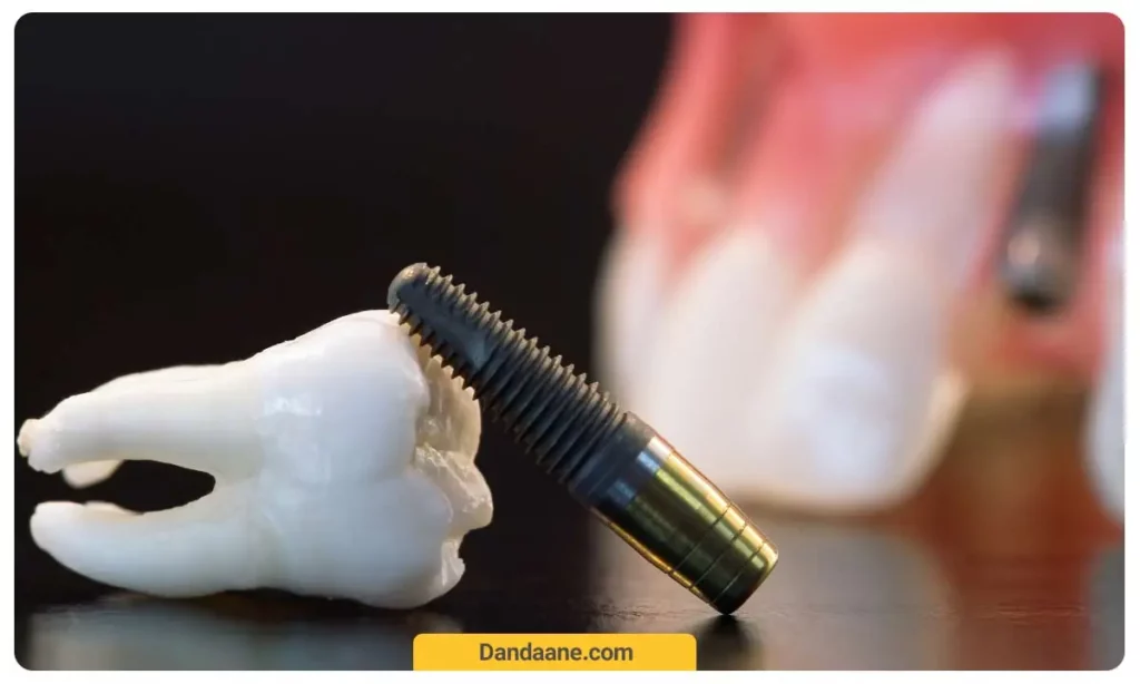 تصویر پایه ایمپلنت دندان 