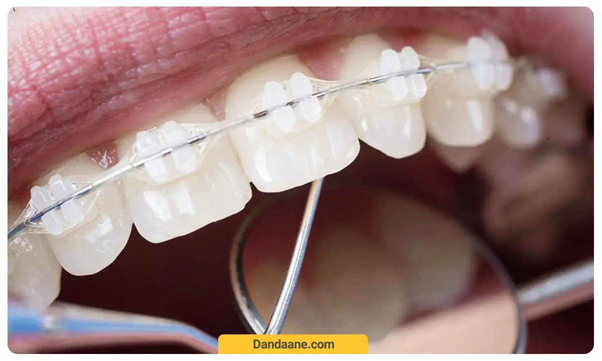 بریس ارتودنسی سرامیکی