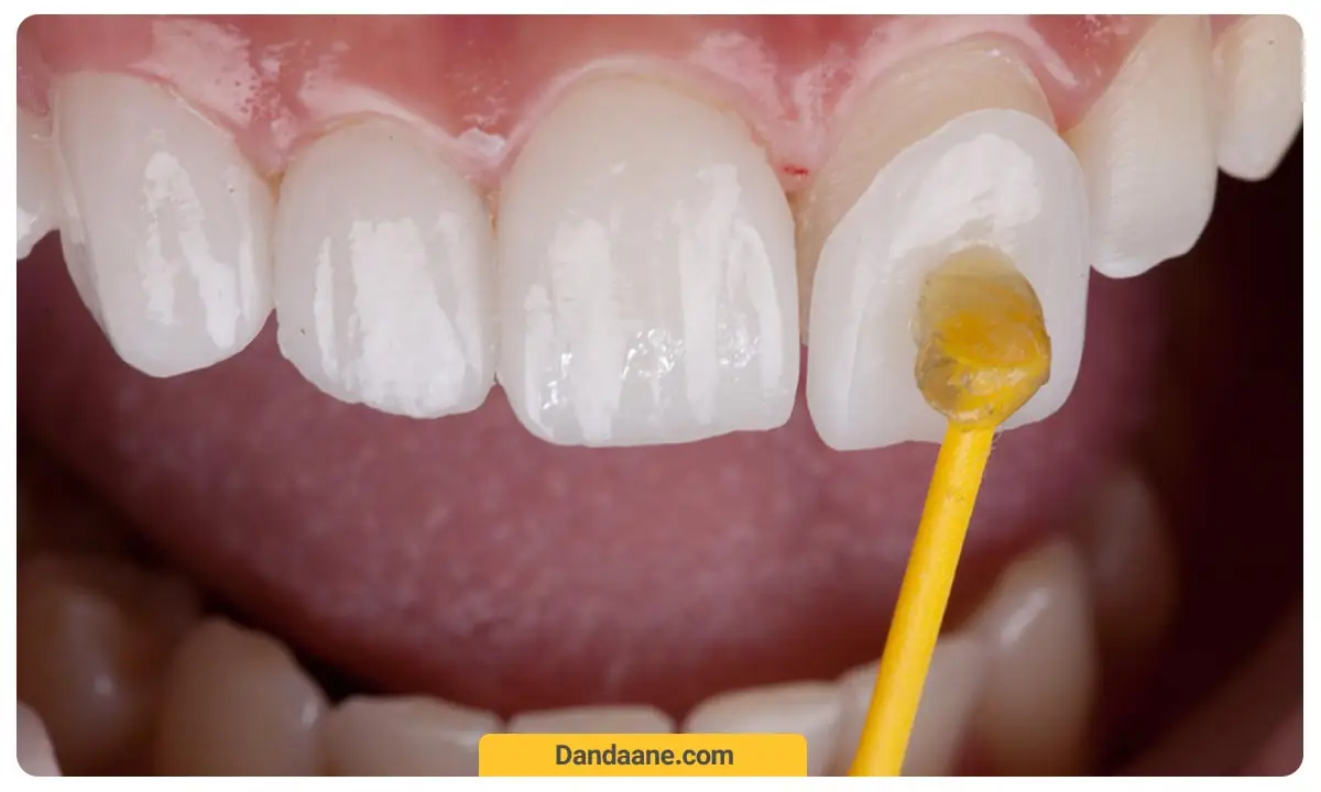 نحوه جاگذاری چسب لمینت