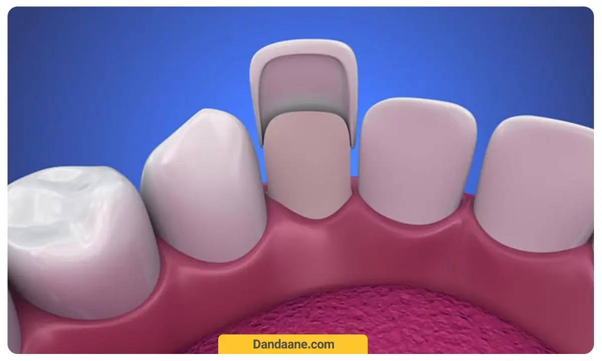 تصویر شماتیک از قرارگیری لمینت بر روی دندان