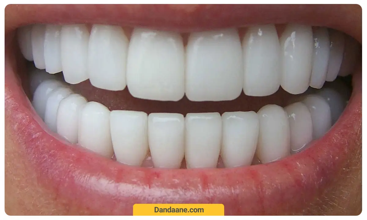 تصویر دوفک با دندان های لمینت شده