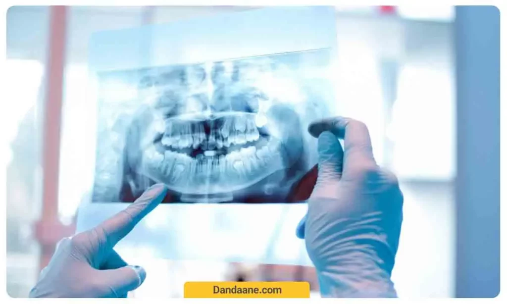 تصویر برداری سه بعدی برای ایمپلنت دیجیتال