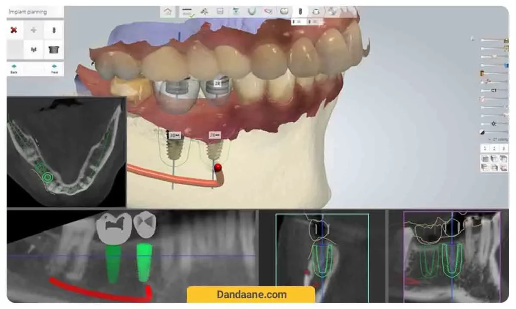 ایمپلنت دیجیتال دندان چیست؟