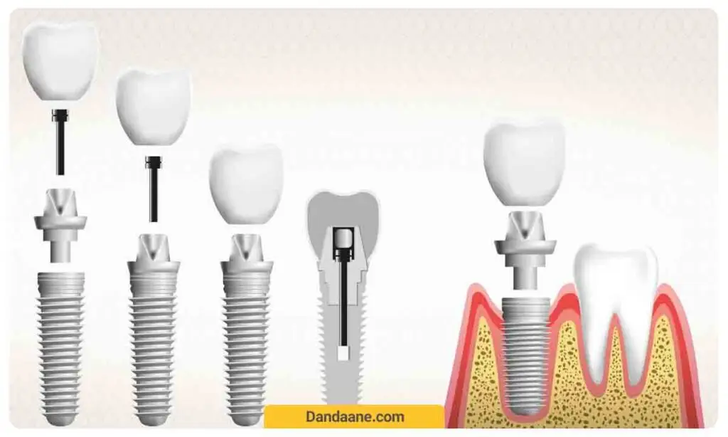 قیمت ایمپلنت دیجیتال چقدر است؟