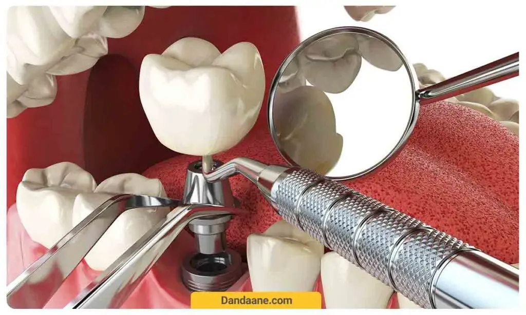 بهترین کلینیک ایمپلنت دیجیتال در تهران