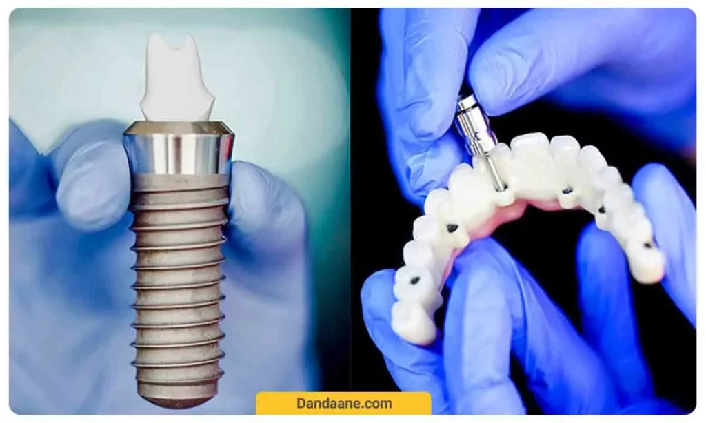 ایمپلنت معمولی دندان چه تفاوتی با ایمپلنت دیجیتال دارد