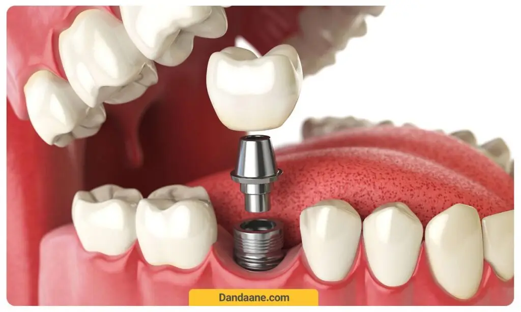 ایمپلنت فوری چیست