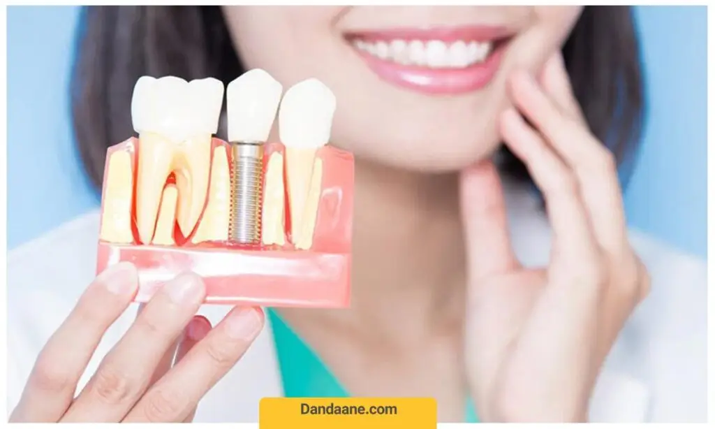 تصویر یک دختر در حال نشان دادن ایمپلنت دندان