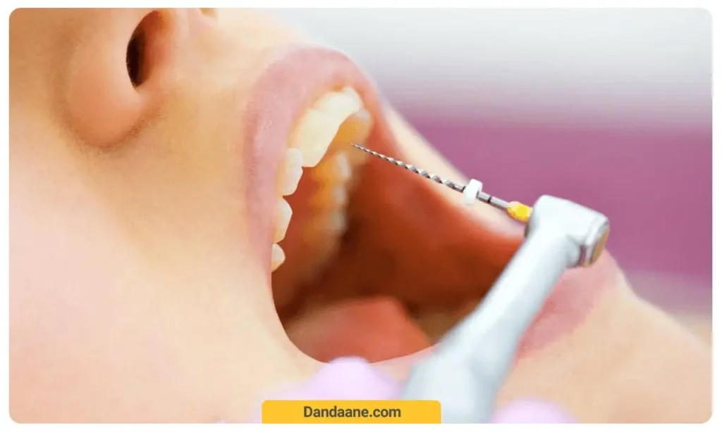 دندانپزشک در حال عصب کشی دندان بیمار 