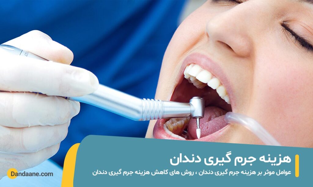 هزینه جرم گیری دندان