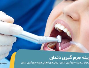 هزینه جرم گیری دندان