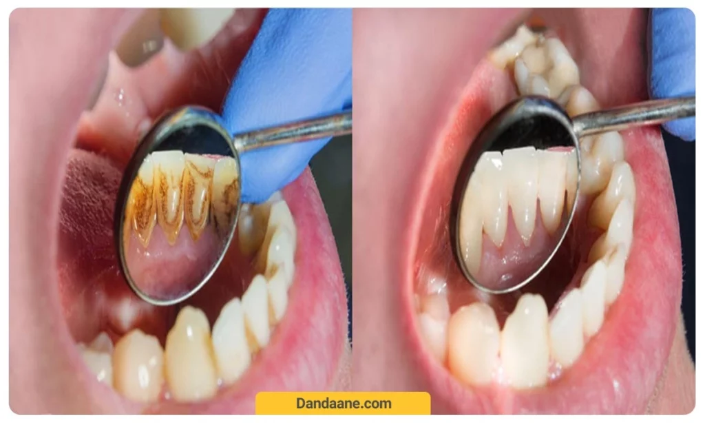 تصویر قبل و بعد از جرمگیری دندان 