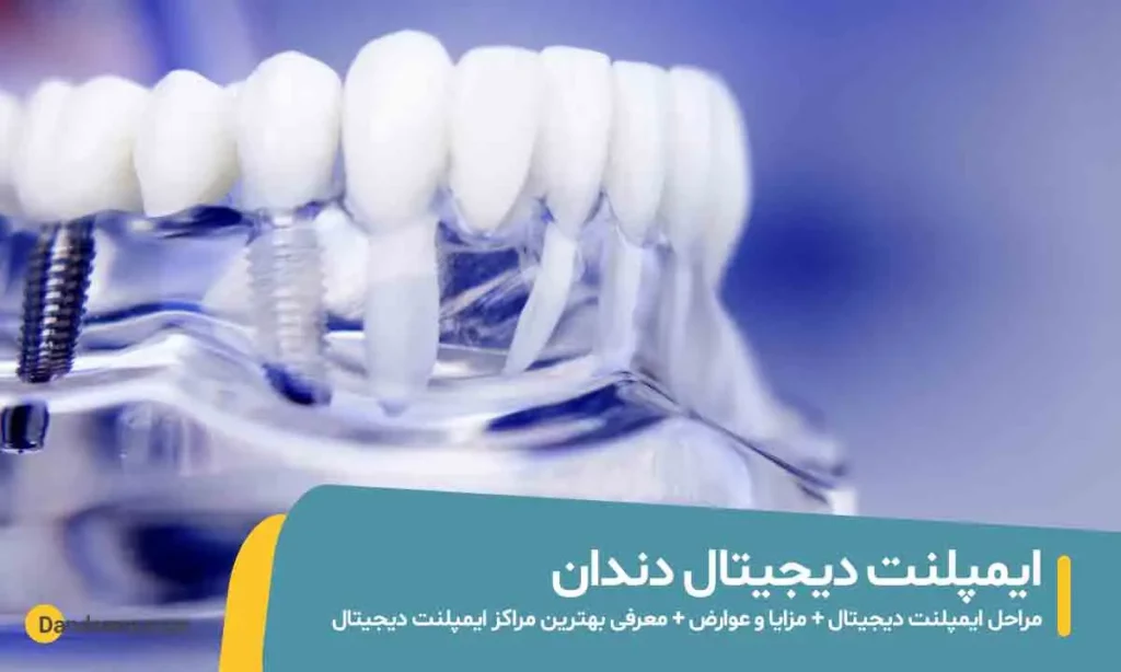 ایمپلنت دیجیتال