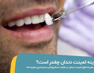 هزینه لمینت دندان عکس