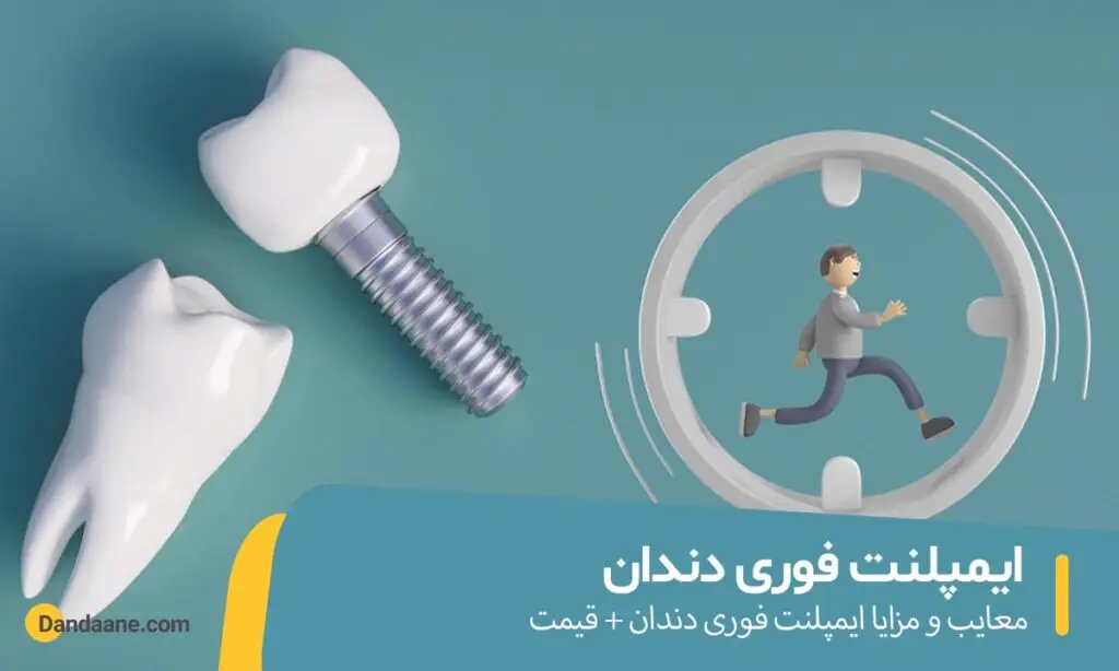 ایمپلنت فوری دندان