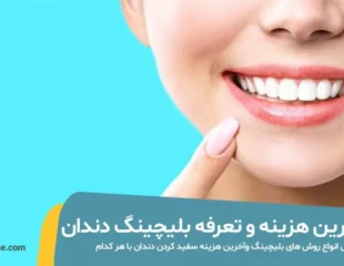 عکس نتایج بلیچینگ دندان در مطب
