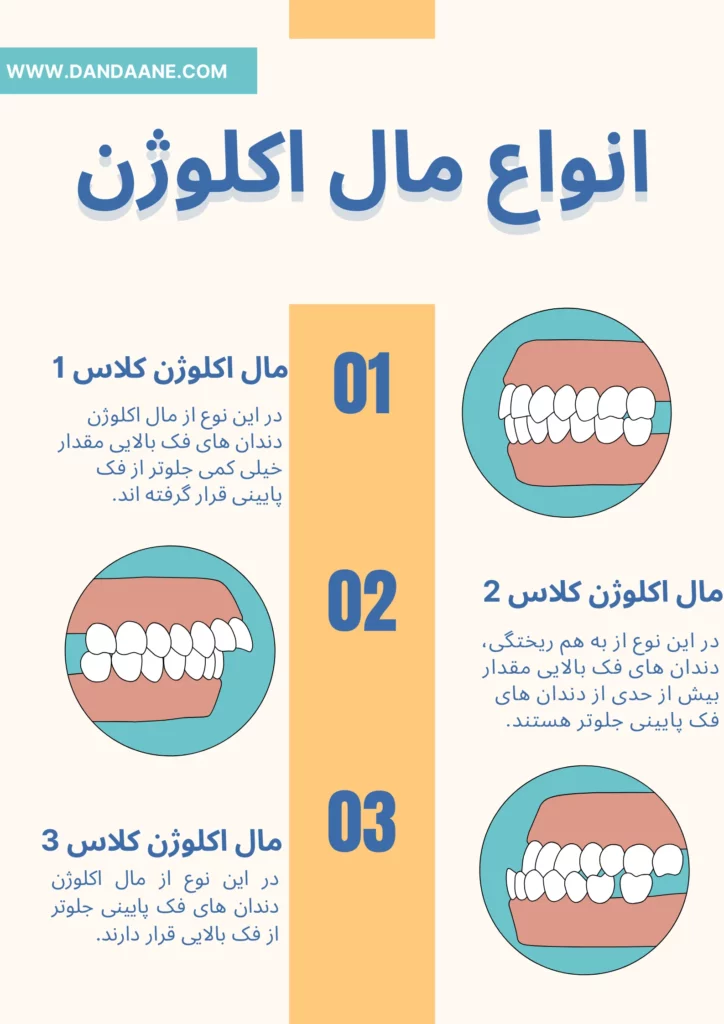 تصویر اینفوگرافی از انواع مال اکلوژن دندان ها 