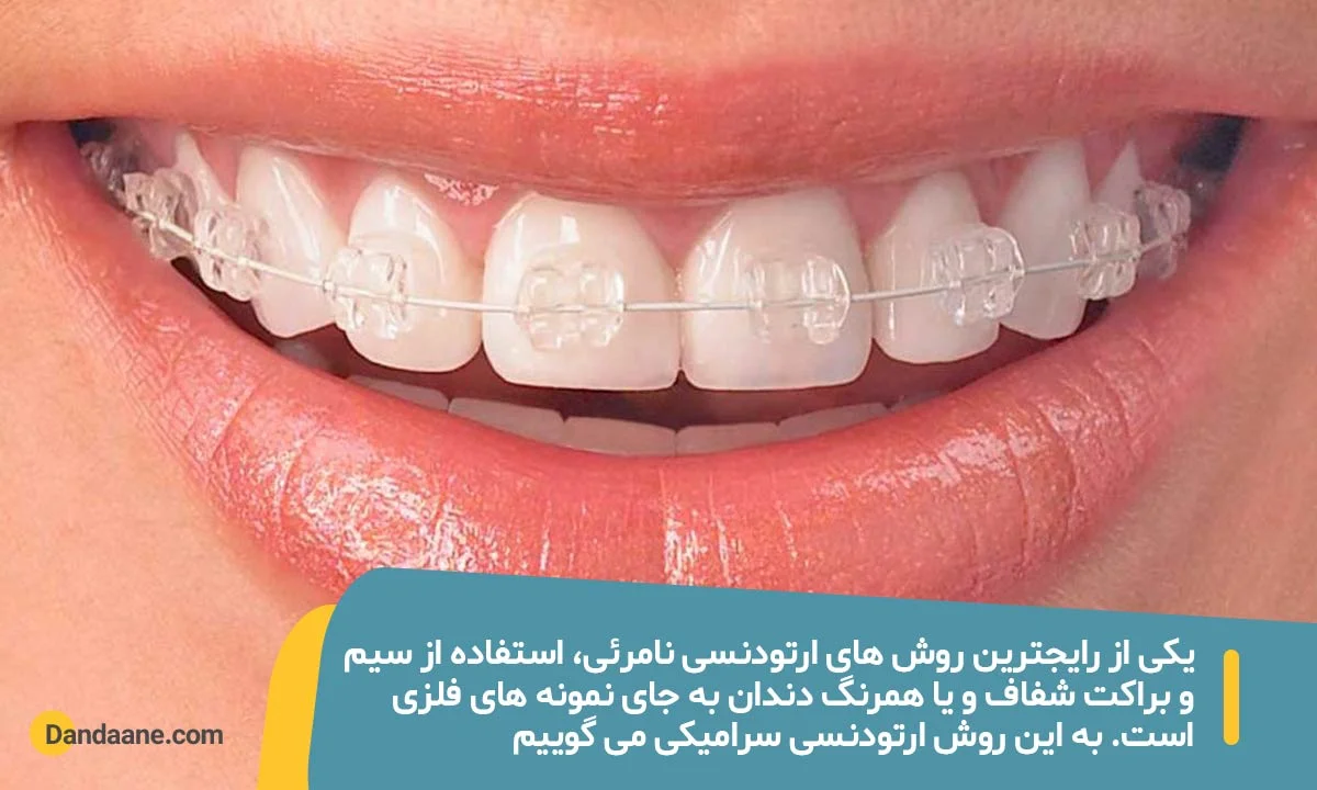 اینفوگرافی ارتودنسی نامرئی سرامیکی