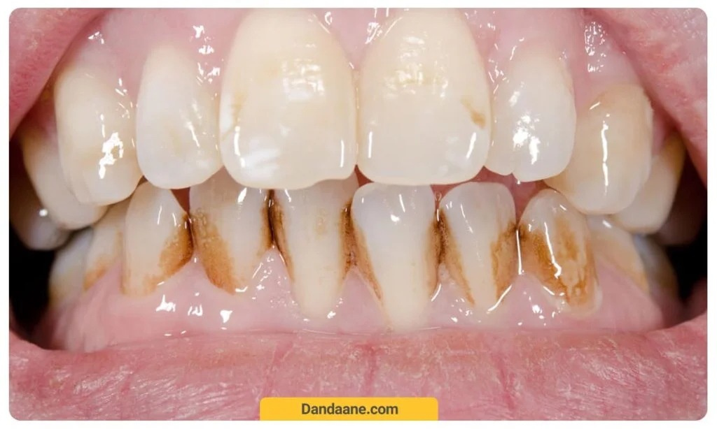 تصویری از ایجادلکه بر روی دندان ها