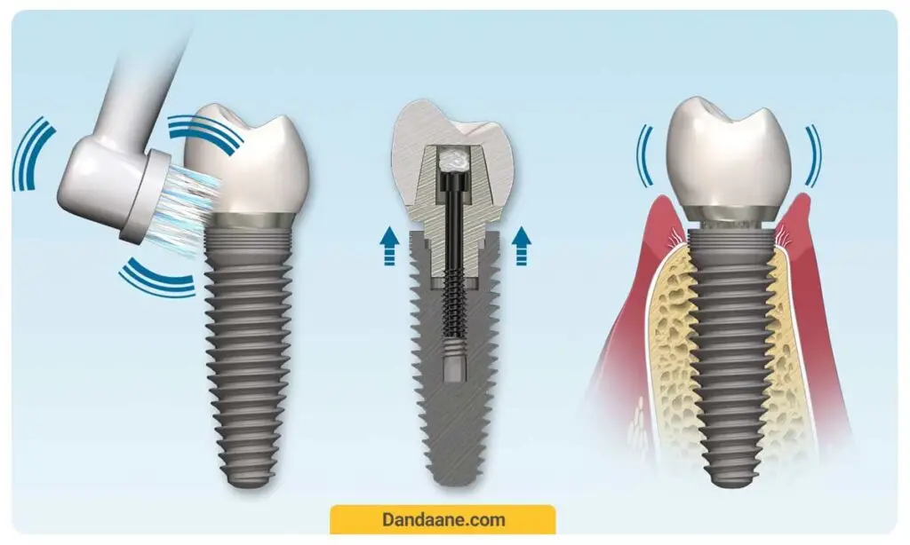 مراقبت های لازم پس از ایمپلنت دندان