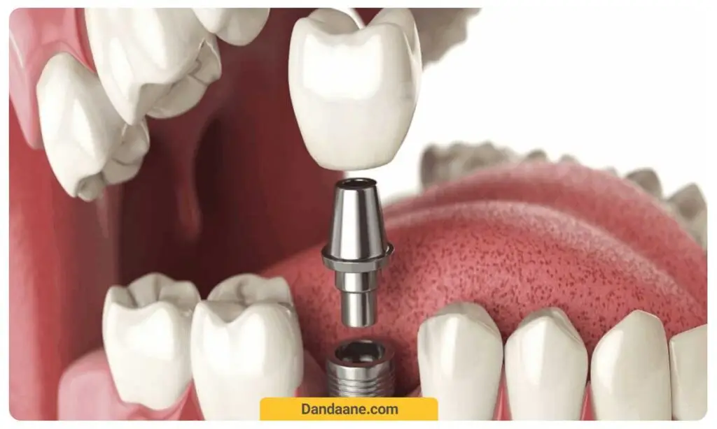 مراقبت پس از ایمپلنت