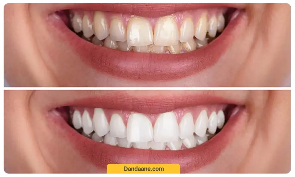 تصویر قبل و بعد از کامپوزیت دندان