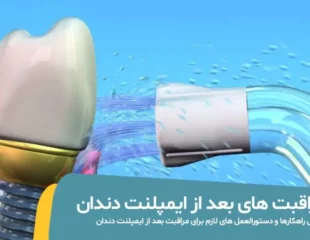 مراقبت های بعد از ایمپلنت دندان
