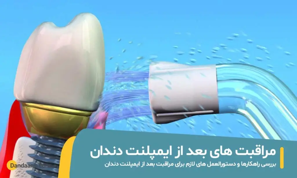 مراقبت های بعد از ایمپلنت دندان