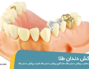 روکش دندان طلا چیست و چه مزایا و معایبی دارد؟